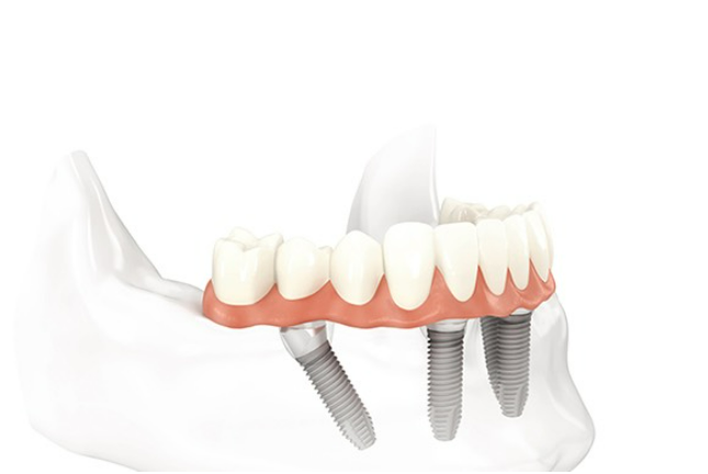 Prix et tarif compétitifs pour implant dentaire de qualité près de Grenoble 38 Isère