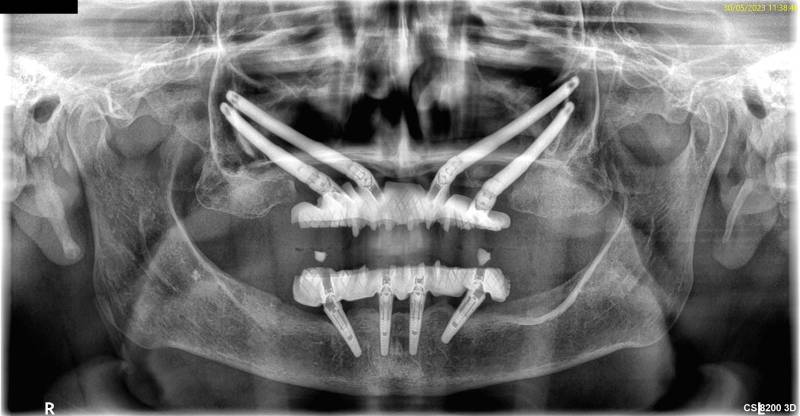 radio panoramique d'implants zygomatiques chez Implantys à Villefranche-sur-Saône près de Mâcon