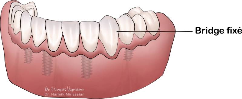 bridgé fixé sur 4 implants