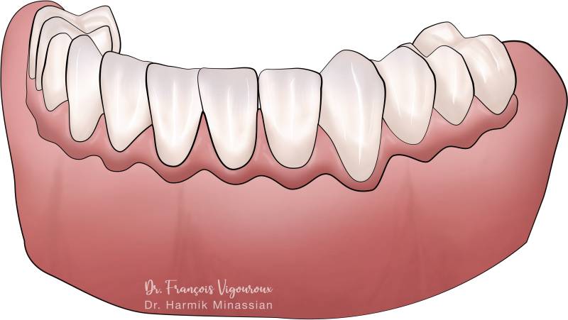 résultat final d'un All on 4® sur mandibule