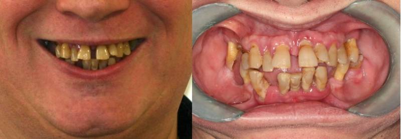 avant implantation avec pose de prothèse immédiate sur toute l'arcade supérieure