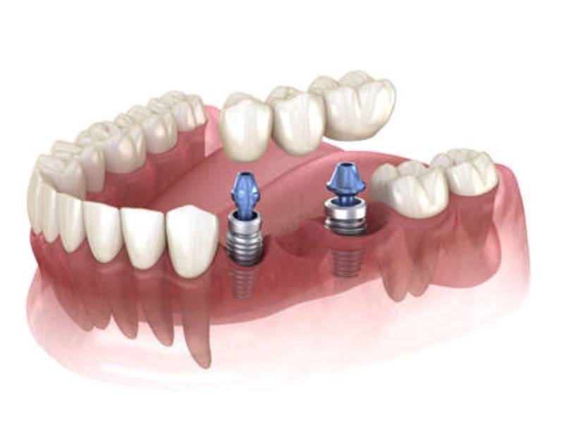 bridge sur implants pour remplacer plusieurs dents manquantes proche de Mâcon