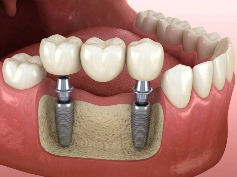 Retrouver des dents fixes en une seule journée grâce à la pose immédiate de bridge sur implants dentaires à proximité de Mâcon
