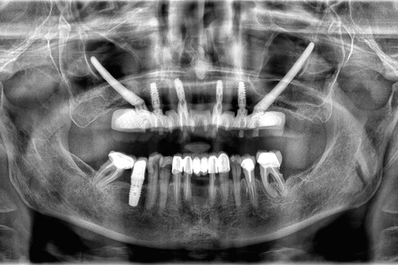 radio panoramique d'implants zygomatiques chez Implantys à Villefranche-sur-Saône près de Mâcon