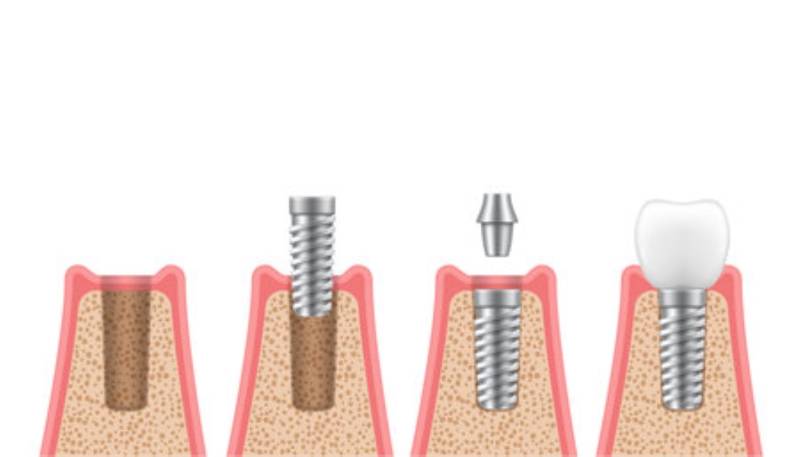 couronne sur implant pour remplacer une dent manquante proche de Mâcon