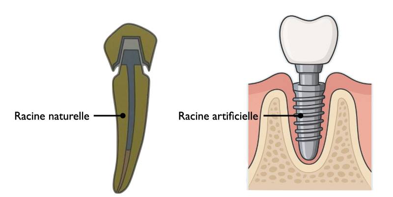 Différence entre une couronne et un implant dentaire