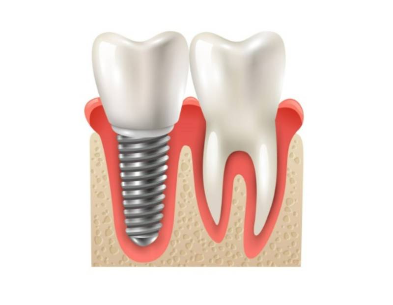 Implants dentaires près de Saint-Didier-au-Mont-d’Or – Traitement spécialisé et personnalisé au cabinet Implantys