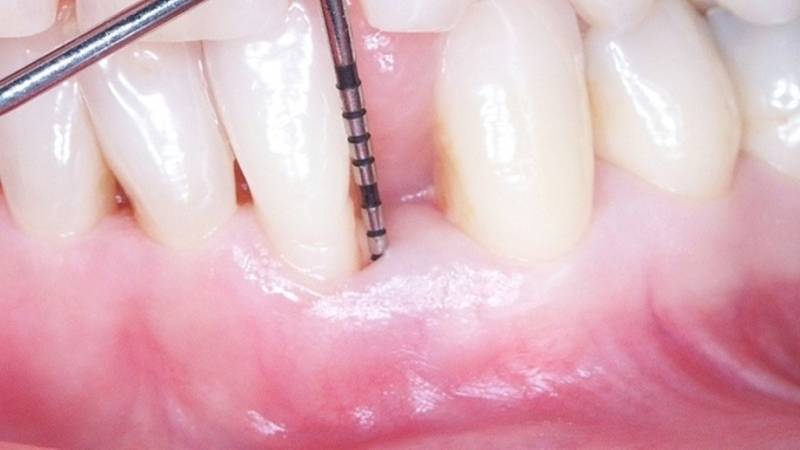 Choisissez un cabinet de parodontologie de confiance près des Monts d'Or pour garantir une greffe gingivale de qualité