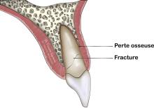 Notre zone d'activité pour ce service Implant zygomatique par chirurgien dentiste qualifié