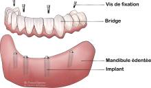 Notre zone d'activité pour ce service Cabinet dentaire pour traitement de caries