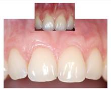 Notre zone d'activité pour ce service Dentiste à près de Grenoble 38 Isère pour devis implant dentaire